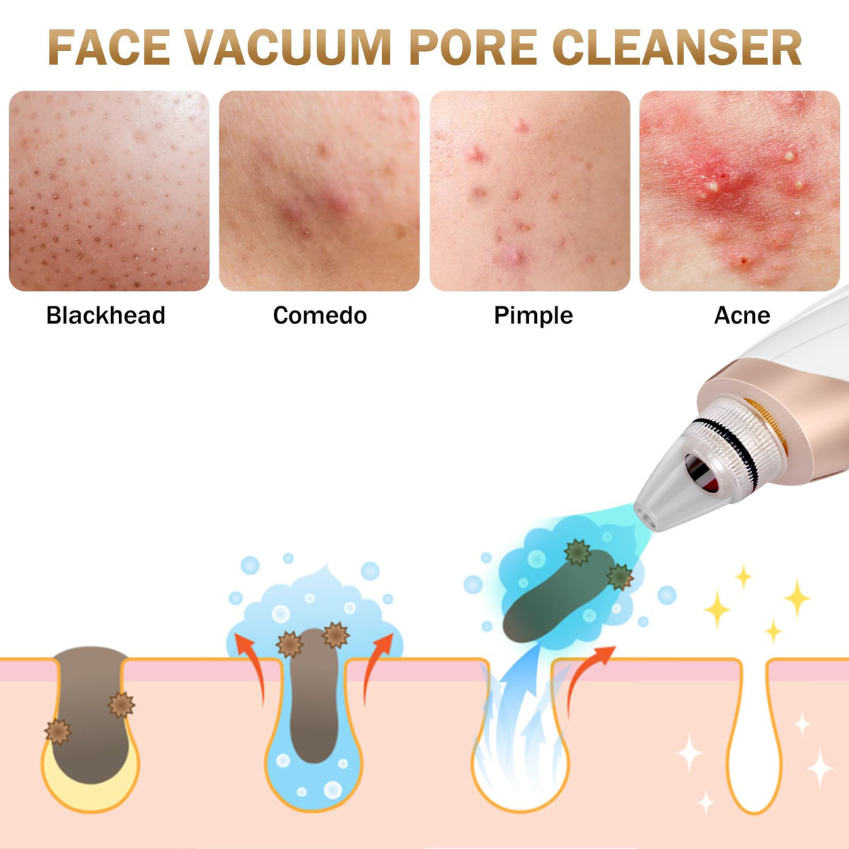 5 in 1 Electric Blackhead Acne Oil Remover Vacuum Suction Face Pore Cleaner Machine